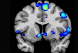 اسکن MRI برای تشخیص محل HIV در مغز