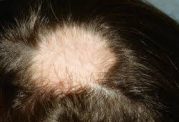 علل رایج برای ریزش موی سکه ای در مردان