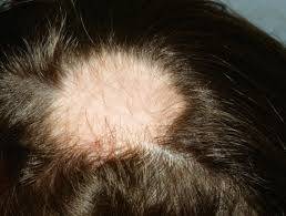 علل رایج برای ریزش موی سکه ای در مردان