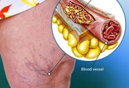 نشانه های مهم برای بروز لخته خون