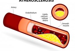 بررسی راهکارهای درمانی عارضه آترواسکلروز