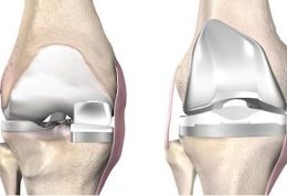 جراحی تعویض مفصل زانو چیست؟