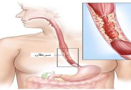 همه چیز را در مورد سرطان مری بدانیم