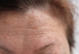 روش های تایید شده برای مقابله با چین و چروک روی پوست