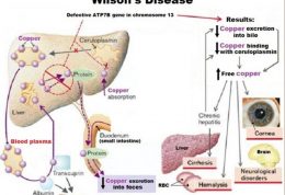 علائم بیماری ویلسون و درمان آن