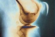 آسیب های ناشی از جراحی های تعویض مفصل زانو