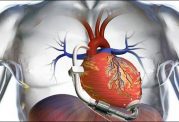 دستگاه قلب و ریه مصنوعی در جنوب کشور راه اندازی شد