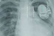 دستگاه ضربان‌ساز قلب جنین ساخته شد