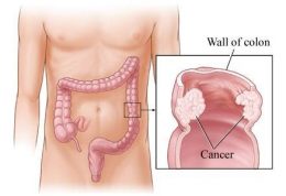 هشدارهای بدن برای سرطان روده بزرگ
