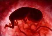 بررسی خطرات بارداری و سقط جنین برای زنان مبتلا به ام اس