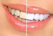 تفاوت های سفید کردن دندان و جرم گیری