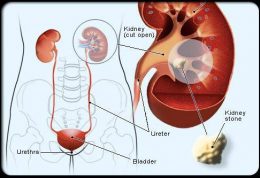 مقابله با تشکیل سنگ در کلیه