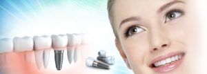 مراقبت از ایمپلنت دندان – قبل و بعد عمل