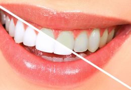 زرد شدن دندان ها از علت تا درمان