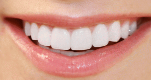 جرم گیری دندان با روش اولتراسونیک
