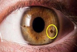 لکه های درون چشم نشان دهنده چیست؟