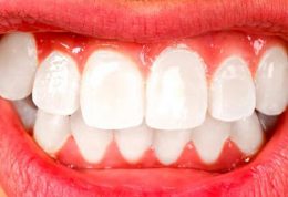 سایش دندان ها و دندان قروچه