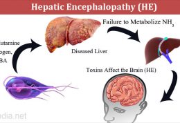 انسفالوپاتی کبدی چگونه در بدن پدید می آید؟