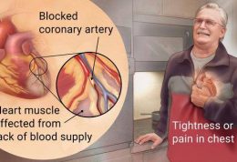 افزایش ریسک سکته مجدد با توقف مصرف استاتین