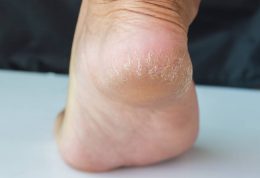 راهکارهای موثر برای درمان ترک های پاشنه پا
