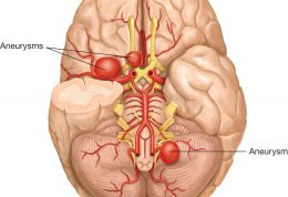 خطر آنوریسم مغزی برای سلامتی