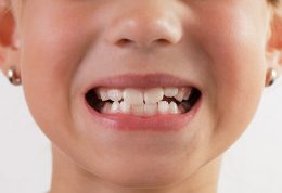 جویدن چه تاثیری بر دندان ها می گذارد؟