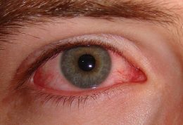 چگونه مانع از عفونت چشم ها شویم؟