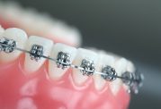 ارتودنسی دندان دکتر بهروزی