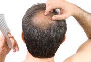 کاشت مو قطعی ترین روش درمان ریزش مو از نظر دکتر رحمانی