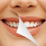مزایا و عوارض بلیچینگ دندان از زبان دکتر بهروزی