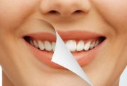 مزایا و عوارض بلیچینگ دندان از زبان دکتر بهروزی