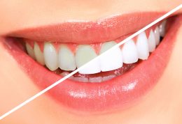 بلیچینگ و سفید کردن دندان با لیزر چگونه انجام می شود؟