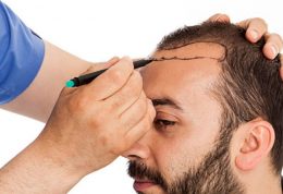 جدیدترین شیوه کاشت مو و ابرو در کلینیک تندیس