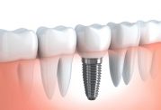 دکتر ادیب: مزیت های ایمپلنت دندان
