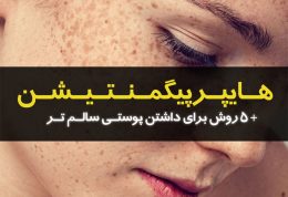 هایپرپیگمنتیشن چیست ؟ علل درمان هشدارها و نکات کلیدی