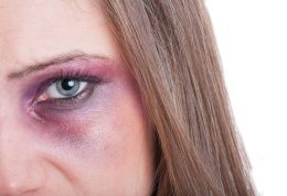 درمان خون مردگی و کبودی زیر چشم در اثر ضربه – درمان خانگی