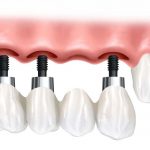 دکتر نوروززاده: توضیحات مفید در مورد ایمپلنت دندان