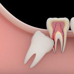 دکتر نوروززاده: دندان نهفته چیست و چه خطراتی به دنبال دارد؟