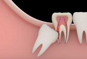 دکتر نوروززاده: دندان نهفته چیست و چه خطراتی به دنبال دارد؟