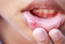 روش های درمان زخم‌ها و آفت های دهان