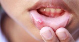 روش های درمان زخم‌ها و آفت های دهان