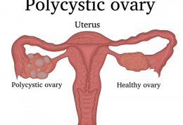 درمان های ویژه برای تخمدان پلی کیستیک