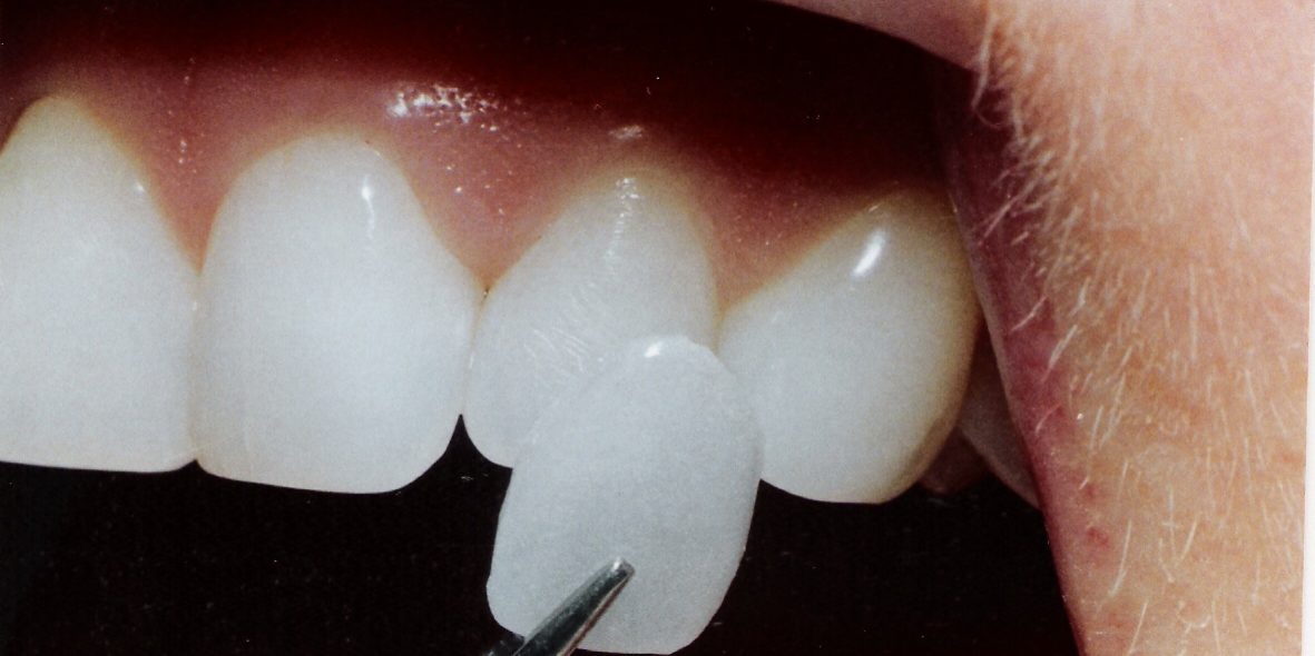 لمینت دندان تا چه اندازه به دندان آسیب می رساند؟