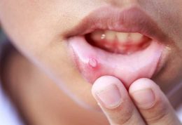 نکاتی مهم در خصوص درمان زخم دهان