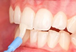 کاهش شاخص پوسیدگی دندان ها با وارنیش فلورایدتراپی