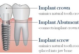 انواع ایمپلنت دندانپزشکی نارمک