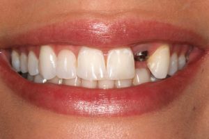 دکتر منیره تهرانی:ایمپلنت دندانی چیست و چگونه انجام می شود؟