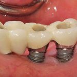 دکتر نوروززاده: چگونه ایمپلنت دندان را نگهداری کنیم؟