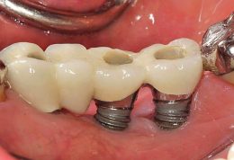 دکتر نوروززاده: چگونه ایمپلنت دندان را نگهداری کنیم؟