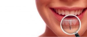 دکتر منیره تهرانی:ایمپلنت دندانی چیست و چگونه انجام می شود؟